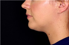 Nonsurgical Fat Reduction After Photo by Landon Pryor, MD, FACS; Rockford, IL - Case 45013