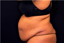 Tummy Tuck Before Photo by Landon Pryor, MD, FACS; Rockford, IL - Case 45014