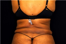 Tummy Tuck After Photo by Landon Pryor, MD, FACS; Rockford, IL - Case 45014