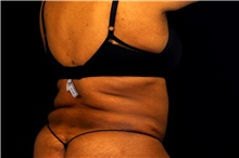 Tummy Tuck After Photo by Landon Pryor, MD, FACS; Rockford, IL - Case 45014