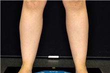 Liposuction Before Photo by Landon Pryor, MD, FACS; Rockford, IL - Case 45017