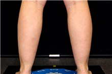 Liposuction Before Photo by Landon Pryor, MD, FACS; Rockford, IL - Case 45017