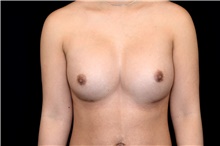 Breast Implant Revision After Photo by Landon Pryor, MD, FACS; Rockford, IL - Case 45019