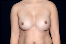 Breast Implant Revision Before Photo by Landon Pryor, MD, FACS; Rockford, IL - Case 45019