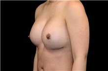Breast Implant Revision After Photo by Landon Pryor, MD, FACS; Rockford, IL - Case 45019