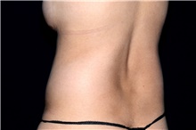 Liposuction Before Photo by Landon Pryor, MD, FACS; Rockford, IL - Case 45020