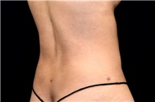 Liposuction After Photo by Landon Pryor, MD, FACS; Rockford, IL - Case 45020