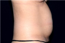 Liposuction Before Photo by Landon Pryor, MD, FACS; Rockford, IL - Case 45020