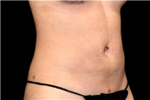Liposuction After Photo by Landon Pryor, MD, FACS; Rockford, IL - Case 45020