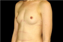 Breast Augmentation Before Photo by Landon Pryor, MD, FACS; Rockford, IL - Case 45022