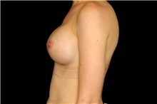 Breast Augmentation After Photo by Landon Pryor, MD, FACS; Rockford, IL - Case 45022