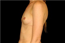 Breast Augmentation Before Photo by Landon Pryor, MD, FACS; Rockford, IL - Case 45022