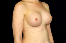 Breast Augmentation After Photo by Landon Pryor, MD, FACS; Rockford, IL - Case 45022