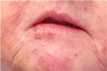 Head and Neck Cancer Reconstruction After Photo by Landon Pryor, MD, FACS; Rockford, IL - Case 45023