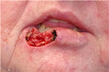 Head and Neck Cancer Reconstruction Before Photo by Landon Pryor, MD, FACS; Rockford, IL - Case 45023