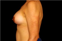 Breast Augmentation After Photo by Landon Pryor, MD, FACS; Rockford, IL - Case 45024