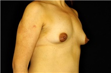 Breast Augmentation Before Photo by Landon Pryor, MD, FACS; Rockford, IL - Case 45024