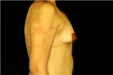 Breast Augmentation Before Photo by Landon Pryor, MD, FACS; Rockford, IL - Case 45024