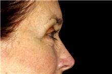 Dermal Fillers Before Photo by Landon Pryor, MD, FACS; Rockford, IL - Case 45025