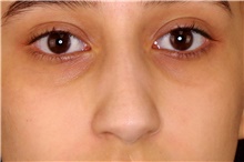 Dermal Fillers Before Photo by Landon Pryor, MD, FACS; Rockford, IL - Case 45026