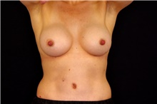 Breast Augmentation After Photo by Landon Pryor, MD, FACS; Rockford, IL - Case 45029