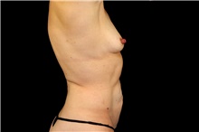 Breast Augmentation Before Photo by Landon Pryor, MD, FACS; Rockford, IL - Case 45029