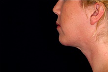 Chin Augmentation After Photo by Landon Pryor, MD, FACS; Rockford, IL - Case 45030