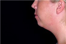 Chin Augmentation Before Photo by Landon Pryor, MD, FACS; Rockford, IL - Case 45030
