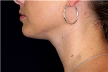Liposuction After Photo by Landon Pryor, MD, FACS; Rockford, IL - Case 45031