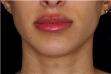 Injectable Fillers After Photo by Landon Pryor, MD, FACS; Rockford, IL - Case 45033