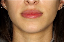 Injectable Fillers Before Photo by Landon Pryor, MD, FACS; Rockford, IL - Case 45033