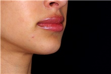 Injectable Fillers After Photo by Landon Pryor, MD, FACS; Rockford, IL - Case 45033