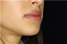 Injectable Fillers Before Photo by Landon Pryor, MD, FACS; Rockford, IL - Case 45033
