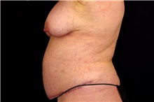 Tummy Tuck After Photo by Landon Pryor, MD, FACS; Rockford, IL - Case 45034