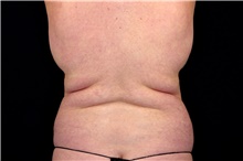 Tummy Tuck Before Photo by Landon Pryor, MD, FACS; Rockford, IL - Case 45034
