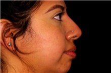 Injectable Fillers After Photo by Landon Pryor, MD, FACS; Rockford, IL - Case 45035