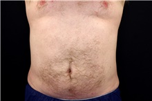 Liposuction After Photo by Landon Pryor, MD, FACS; Rockford, IL - Case 45036