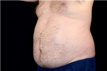 Liposuction Before Photo by Landon Pryor, MD, FACS; Rockford, IL - Case 45036