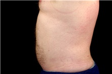Liposuction After Photo by Landon Pryor, MD, FACS; Rockford, IL - Case 45036