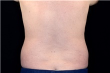 Liposuction Before Photo by Landon Pryor, MD, FACS; Rockford, IL - Case 45036