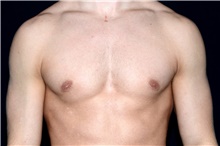 Male Breast Reduction After Photo by Landon Pryor, MD, FACS; Rockford, IL - Case 45039