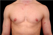 Male Breast Reduction Before Photo by Landon Pryor, MD, FACS; Rockford, IL - Case 45039