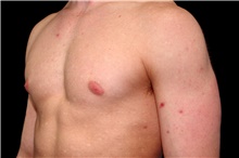Male Breast Reduction Before Photo by Landon Pryor, MD, FACS; Rockford, IL - Case 45039
