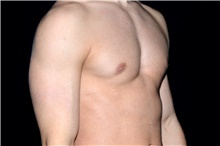 Male Breast Reduction After Photo by Landon Pryor, MD, FACS; Rockford, IL - Case 45039