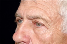Eyelid Surgery After Photo by Landon Pryor, MD, FACS; Rockford, IL - Case 45040