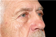 Eyelid Surgery After Photo by Landon Pryor, MD, FACS; Rockford, IL - Case 45040