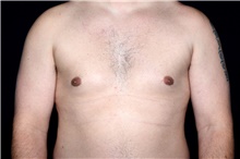 Male Breast Reduction After Photo by Landon Pryor, MD, FACS; Rockford, IL - Case 45041