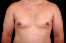 Male Breast Reduction Before Photo by Landon Pryor, MD, FACS; Rockford, IL - Case 45041