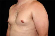 Male Breast Reduction Before Photo by Landon Pryor, MD, FACS; Rockford, IL - Case 45041