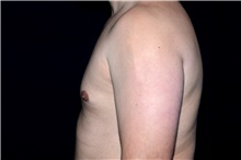 Male Breast Reduction After Photo by Landon Pryor, MD, FACS; Rockford, IL - Case 45041